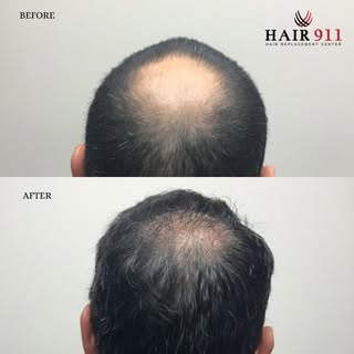 FUE Hair Restoration: 2000 Grafts 

This 43-year-old male had been experiencing gradual hair thinnin