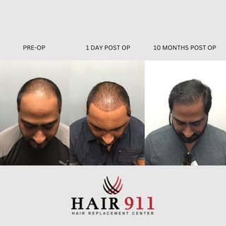 This 31-year-old male noticed gradual hair thinning over the years, with noticeable worsening in the