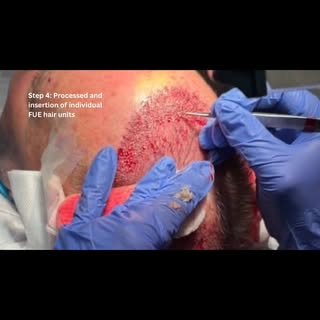 “Follicular unit extraction” scarless hair restoration.

  Thinking about a procedure? You’re just o