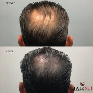 FUE Hair Restoration: 2000 Grafts
This 48-year-old male had been experiencing gradual hair thinning 