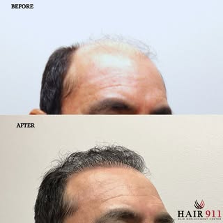 FUE Hair Restoration: 2000 Grafts
This 43-year-old male had been experiencing gradual hair thinning 