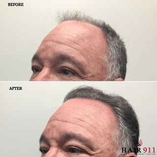 FUE Hair Restoration: 2500 Grafts
This 50-something male experienced gradual thinning of the front a