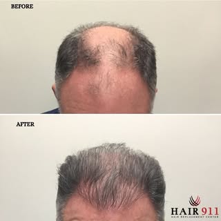 Check out the incredible transformation of this 55-year-old patient who was frustrated with his hair