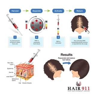 ✨ Struggling with thinning hair or hair loss? PRP (Platelet-Rich Plasma) therapy might be the soluti
