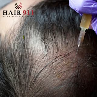 Struggling with thinning hair or hair loss? PRP might be the solution. 💉✨
Platelet-Rich Plasma (PRP