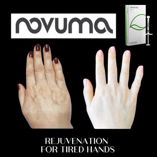 Novuma is a Calcium based filler that also brings up your own collagen. In areas like the hands it o