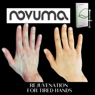 Novuma is a Calcium based filler that also brings up your own collagen. In areas like the hands it o