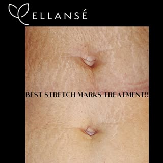 Ellanse is a powerful biostimulator that can be used in face areas. But did you know it is the perfe