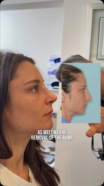 A stunning transformation 😍✨

This patient’s rhinoplasty focused on refining the profile, including