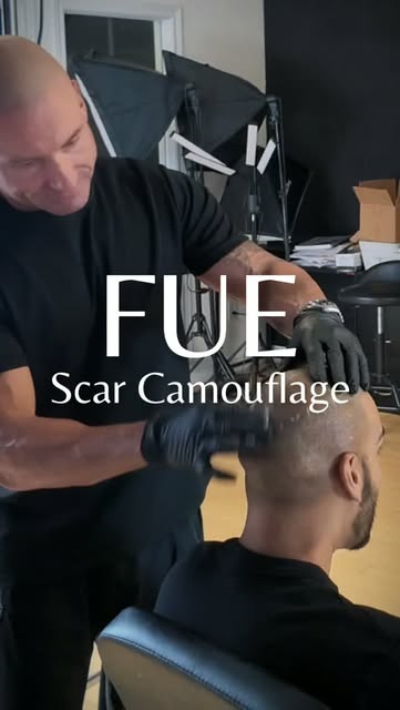 Session one of FUE scar camouflage.

This client had a previous hair transplant that left significan