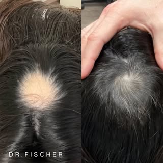 Alopecia Areata is an autoimmune disease of the hair follicle resulting in nonscarring hair loss. 

