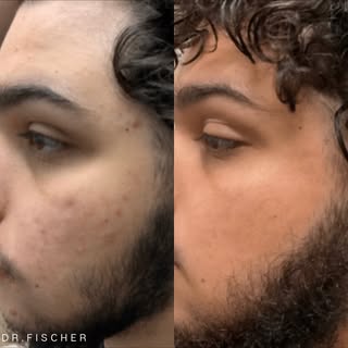 This patient completed a course of Isotretinoin that cleared his acne. For the appropriate patient, 