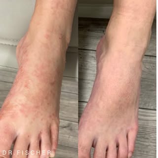 Rashes on the hands and feet are the worst! 
This patient had a flare of dyshidrotic eczema, a type 