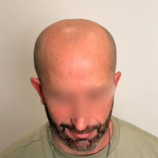 ✨ Antes vs Después ✨ 

Así es como se ve una micropigmentación capilar bien hecha 👌 

Efecto rapado