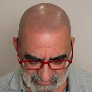 Antes y después de una micropigmentación capilar efecto rapado. ✨

Una de las cosas más bonitas de e