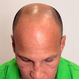 No se trata solo de recuperar cabello, sino de recuperar confianza. ✨

Ver este antes y después tan 