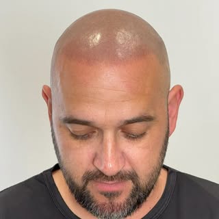 🔥 Un cambio sutil que lo cambia todo.

En este caso realizamos una micropigmentación capilar efecto