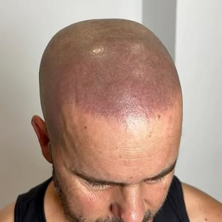 No se trata solo de recuperar el aspecto del cabello… Se trata de recuperar la confianza. 💯

Este i