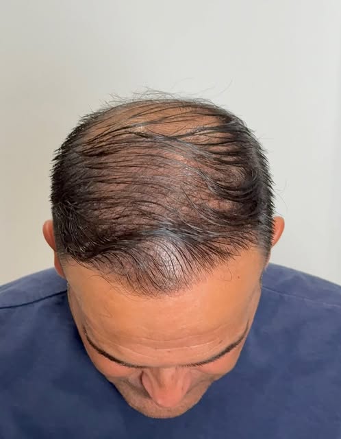 ✨ ANTES Y DESPUÉS | EFECTO DENSIDAD ✨

En este caso, nuestro cliente ya se había realizado un injert