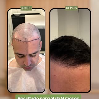 Resultado muito bonito e natural. O resultado final só será alcançado após 12 meses. Densidade d nat