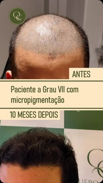 Paciente da clínica Quero Cabelo Grau VII e com micropigmentação (tatuagem). Após 10 meses, resultad