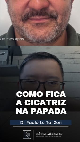 Uma das dúvidas que mais aparecem quando falamos sobre transplante capilar é: a extração dos fios de