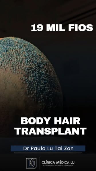 Pós imediato #transplantecapilar com mais de 19 mil fios transplantados

Calvícies grandes tem soluç