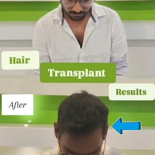 #hairtransformatıon #hairlove #hairlosstreatments #myraskinhairsolutions #hairrestoration