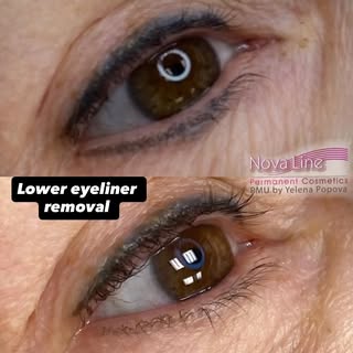 It took two sessions to get rid of the unwanted lower eyeliner tattoo.
#torontopermanentmakeup #tatt
