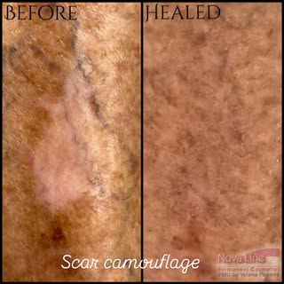 One session. Healed result. Real difference! ✨✨✨
Scar camouflage can significantly reduce the visibi