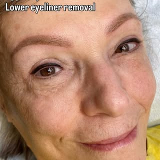 A beautiful result doesn’t always happen in one session.

✨ Lower eyeliner removal
✨ Soft powder bro