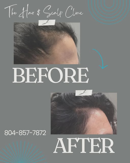 🌱✨ Our advanced Growth Factor & Exosome Regrowth Treatments are designed to support the scalp and h