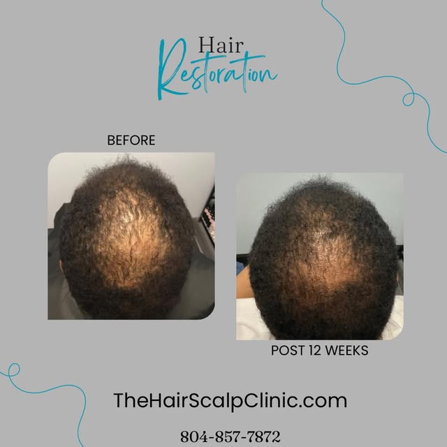 💪🌱 Guys, noticing your hair isn’t as thick as it used to be?

Whether it’s a receding hairline, th
