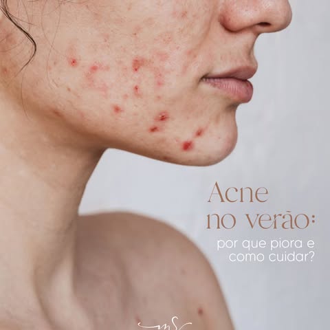 No verão, é comum a acne piorar por causa do calor, do suor e do uso de produtos inadequados para o 