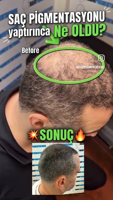 Tuvalim saç pigmentasyonu @hairpigmentations işlemi için Hollanda'dan gelmişti.  1 yıl önce saç simü