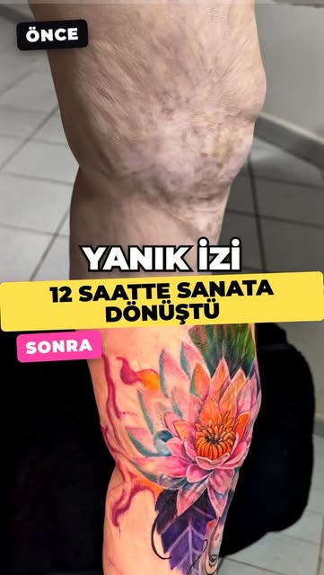 @medikaldovmeler ile Yanık İzi kamuflajı; Derisi kimyasal bir sıvıyla yanmış bir kadın düşünün. Bu y