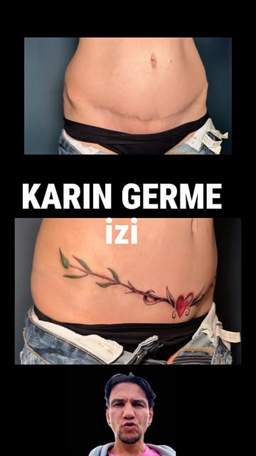 Anne estetiği geçirmiş tuvalim karın germe operasyonu yaptırmış. Bu izler bikini bölgesinde ve kendi