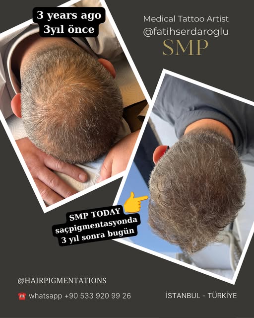 İyi yapılmış bir saç pigmentasyonu @hairpigmentations işlemini aylar ve yıllar sonra çok daha net an