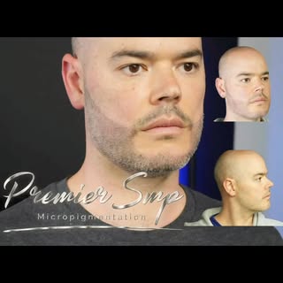 Transform your look with Scalp Micropigmentation! Achieve a natural, fuller hairline and boost your 