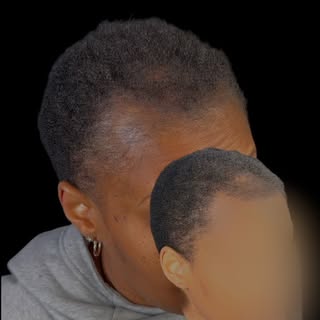 SMP is the number 1 hair loss solution! Get in touch with us now for same day results and make the b