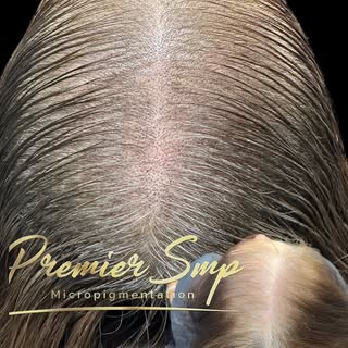 Unveil Hair Density! Our Scalp Micropigmentation sessions are here to empower women with fuller, mor