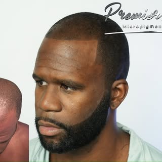 ✨ Scalp Micropigmentation (SMP): The Perfect Solution for Thinning Hair or Hair Loss! ✨

✔️ Instant,