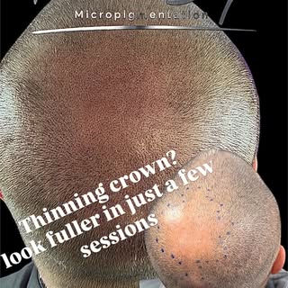 🔥 Thin crown? Sparse density? No problem.

This client wanted the appearance of thicker, fuller hai