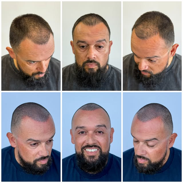 BEFORE ➡️ AFTER - 3 sessions of SMP 🔥

Top row: Alfredo’s hair transplant. It gave him hair, but it
