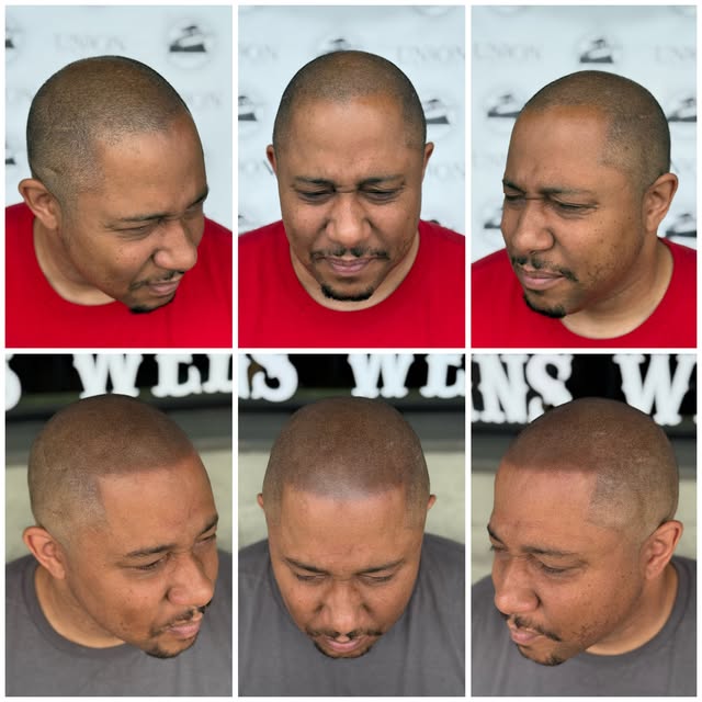 BEFORE ➡️ AFTER 🔥

Top: receding hairline, thinning on top he was tired of it.

Bottom: a clean, na