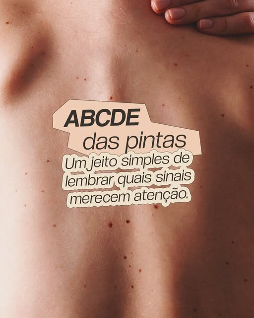 O ABCDE é uma forma prática de lembrar quais características de uma pinta podem indicar que ela mere