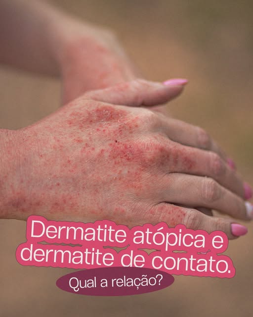 Na dermatite atópica, a barreira da pele é naturalmente mais permeável e vulnerável. Existe uma falh