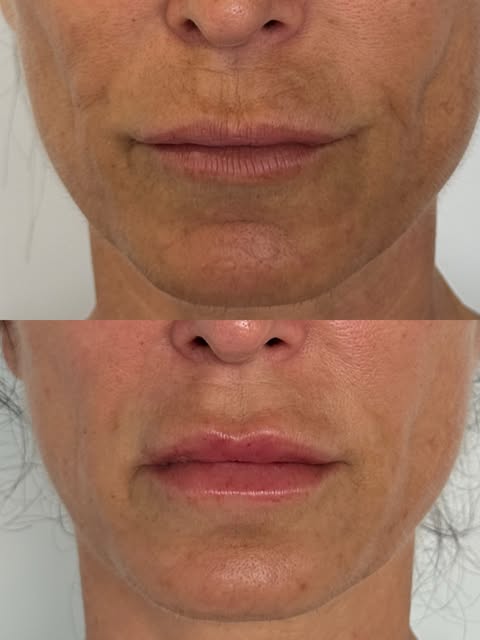 Rejuvenecer los labios sin cambiar su esencia ✨
 Trabajo de la @dra.silviaverlato . Un resultado nat