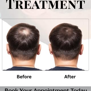 Your hair. Your growth factors. Real results.
GFC Therapy activates weak follicles and improves hair
