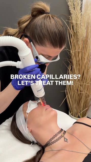 Those tiny red veins that just won’t budge? Aerolase can help!

Using laser energy to target visible
